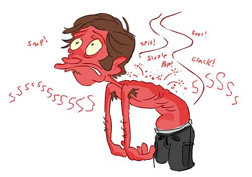 sunburn
