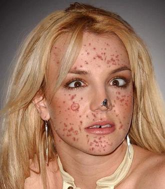 britney-acne