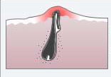 cuerpo depilado_evitar pelo enquistado_tratamiento foliculitis_pseudofoliculitis_laser