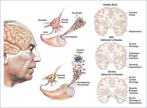 Alzheimer esquema