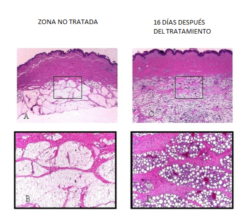 criolipolisis