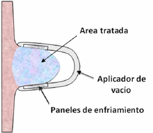 criolipolisis2