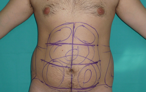 Antes-de-liposuccion