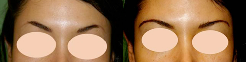 microinjertos-de-cejas-antes-y-despues