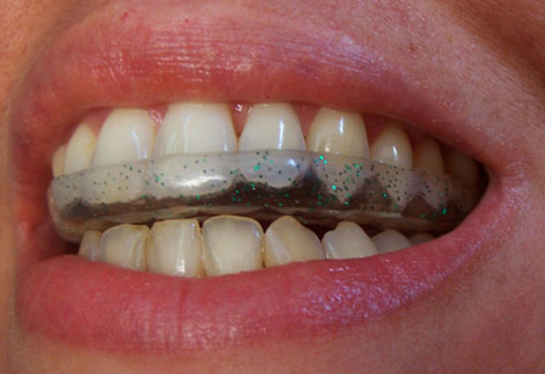 Bruxismo, el rechinar de dientes un problema de ajuste