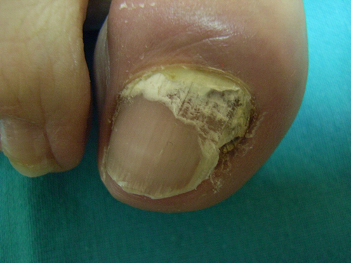 onicomicosis