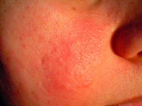 Aspecto de la rosácea