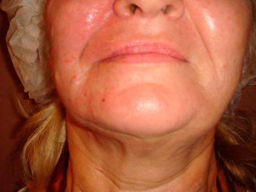 imagen retensado facial