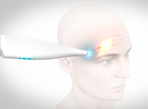 frotox-myoscience-nuevo-botox-nervios-congelados-arrugaas-frente