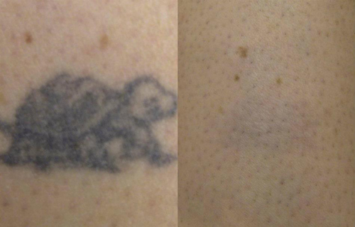 tattoo-cleaners-eliminacion-tatuajes-antes-y-despues