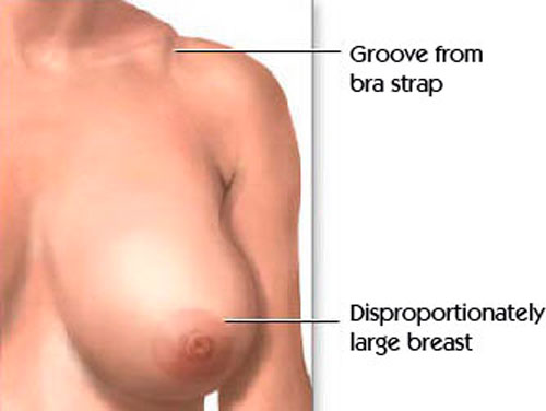 breast reduction