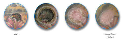 skinial-proceso-borrar-tatu