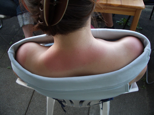 Mujer quemada en una silla Sunburnt_neck500 bja