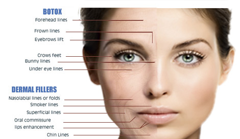 botox arrugas fillers