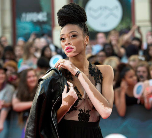 winnie-harlow-vitiligo