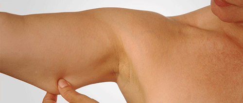 antes-del-lifting-de-brazos
