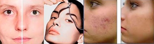 peeling-medico-estetico-cual-es-el-mio-3