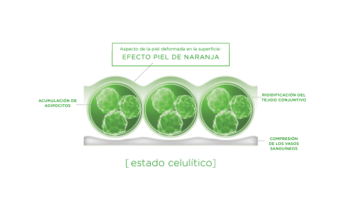 tejido-conjuntivo-periférico---estado-celulítico2
