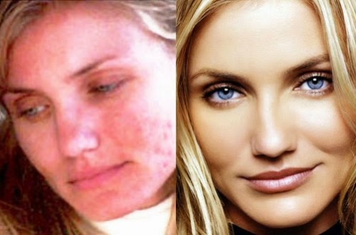 rosacea piel dermatologo