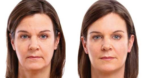 Rejuvenecimiento facial con rellenos de Allergan