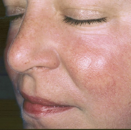 Rosacea