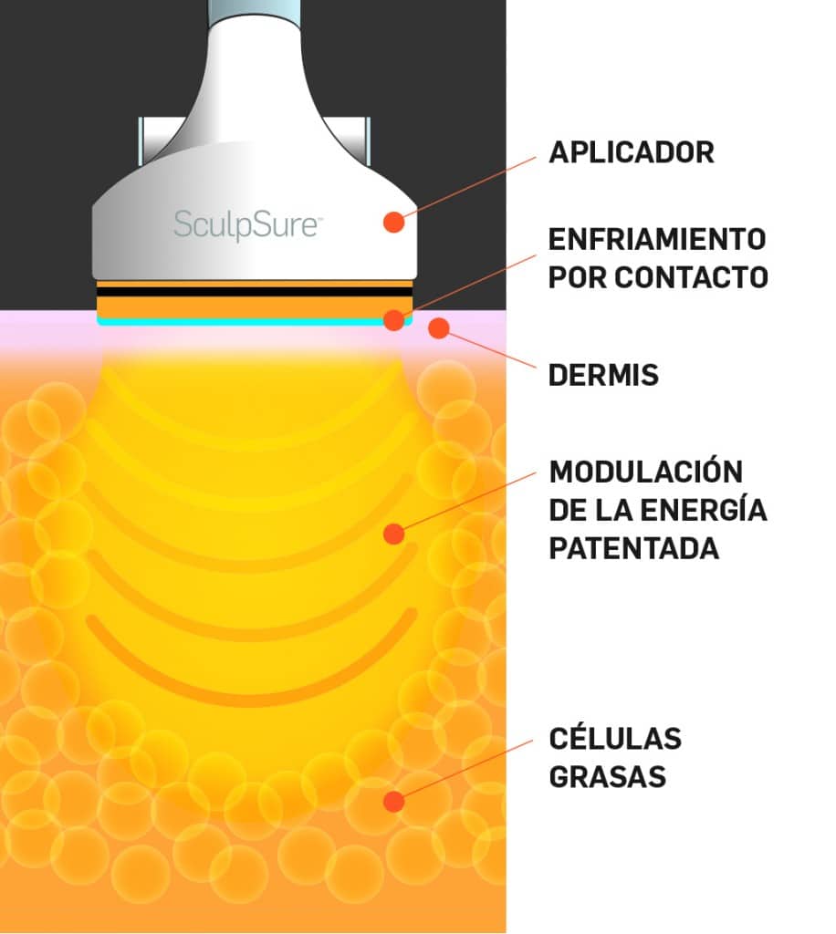 SculpSure 1