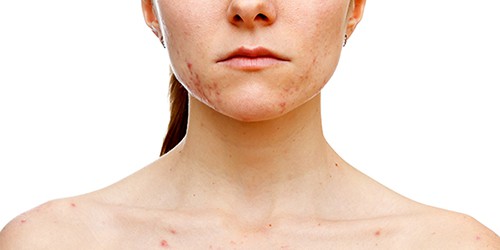 acne-mujer-adulta-ducray-1 acne-mujer-adulta-ducray-1