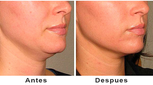 cuello-phone-soluciones-1 cuello-phone-soluciones-1