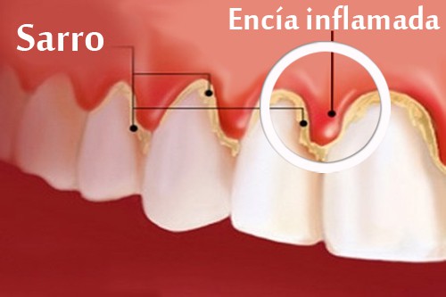 gingivitis dientes