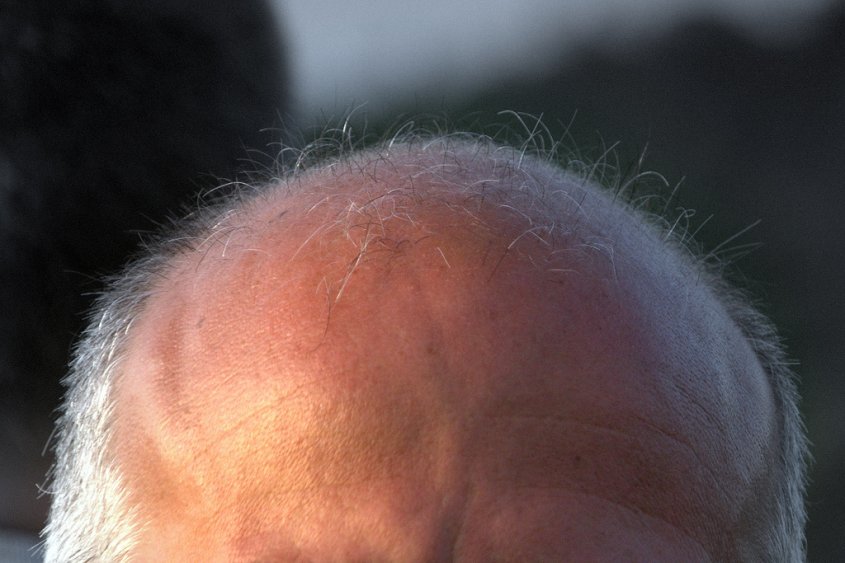 alopecia