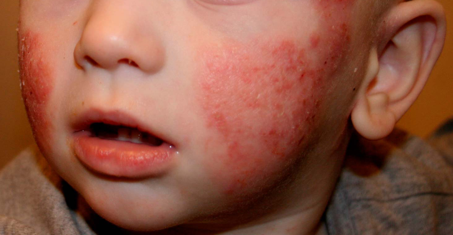 Dermatitis En Niños
