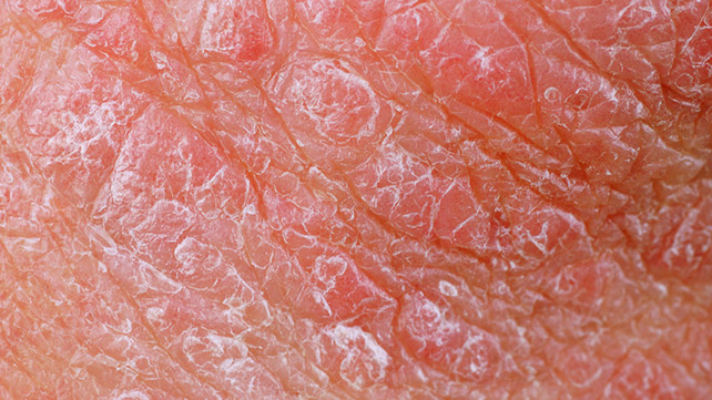 El preparado para uso interno a la psoriasis