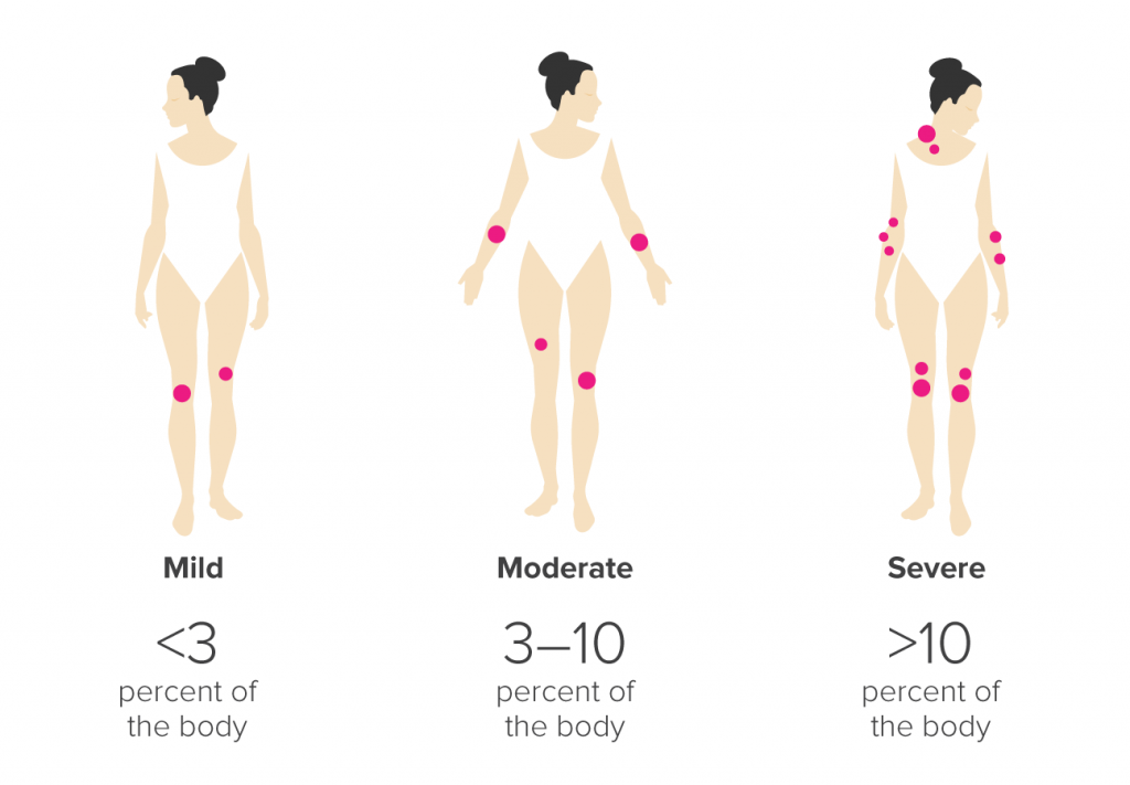 La psoriasis, psicosomática y tratamiento BellezaPura