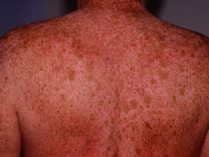 Como arreglar los granos y las pecas de la cutis