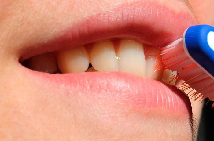 sarro dental antes y despues de adelgazar