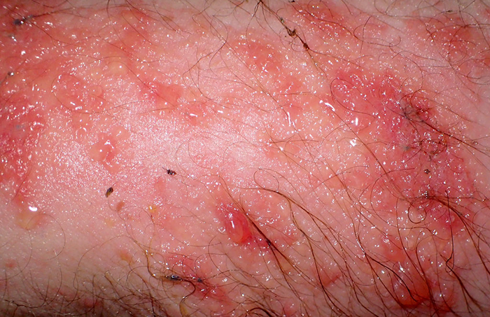 Eczema detalle
