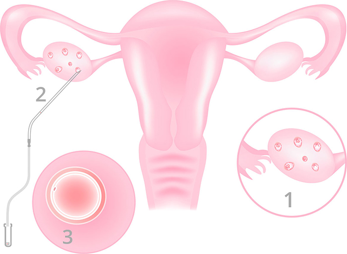 vitrificacion-de-ovulos-2