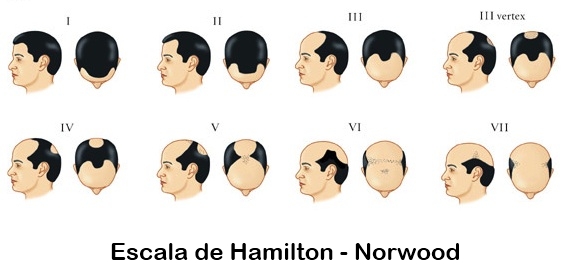 Escala Alopecia Masculina Hamilton