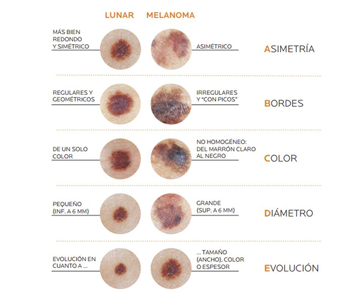 Melanoma