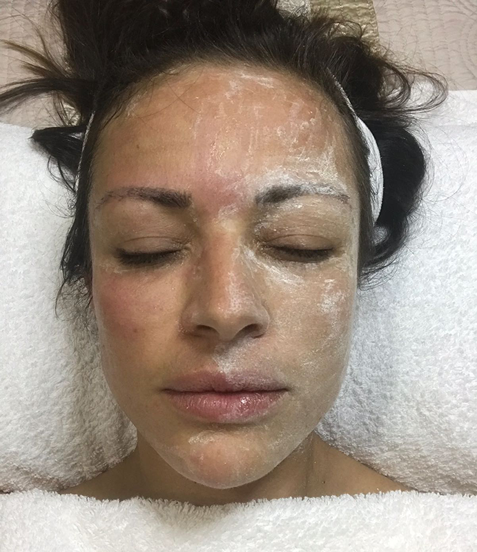 oxigenoterapia facial