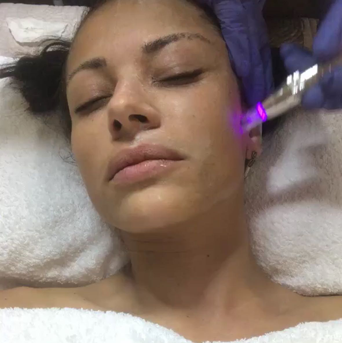 oxigenoterapia facial