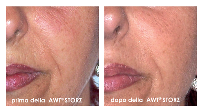 antes y después ondas de choque