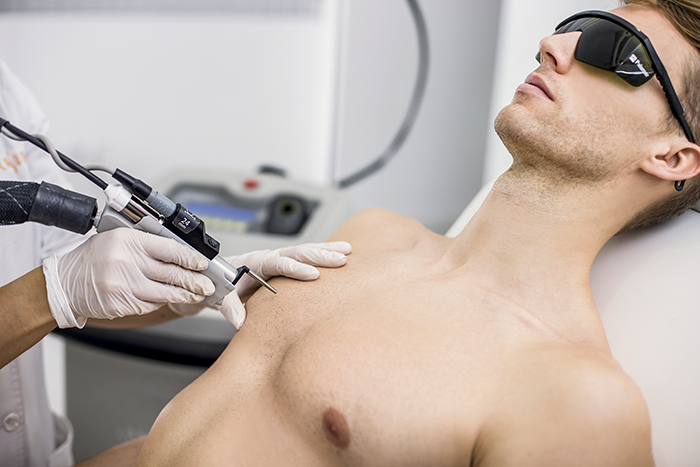 Depilacion Hombre Foliculitis