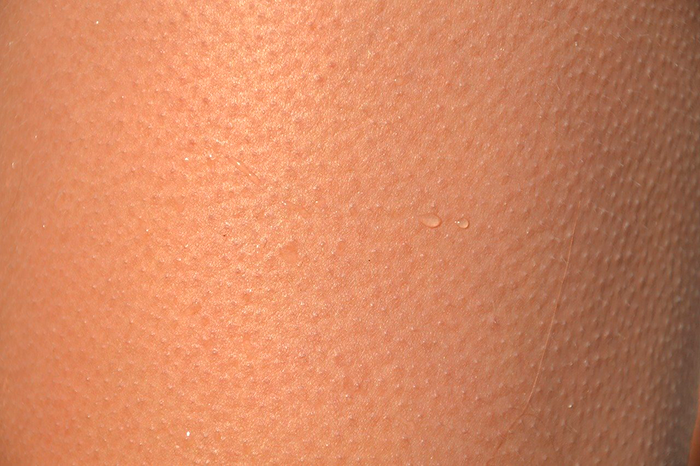 Queratois Pilaris O Piel De Gallina