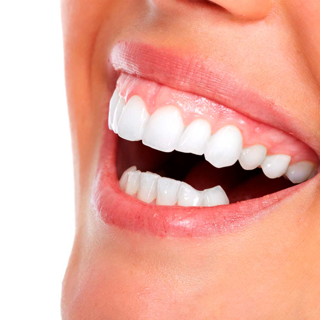 Sonrisa Gingival 1