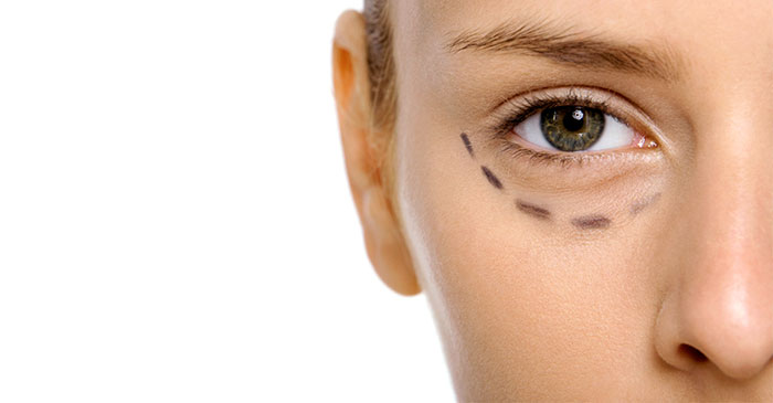 Redensity II para las ojeras tratamientos-medicina-estetica-mirada-3