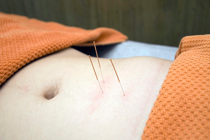 Acupuncture 4175624 1280