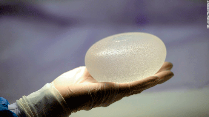 170321223542 Silicone Breast Implant Super 169