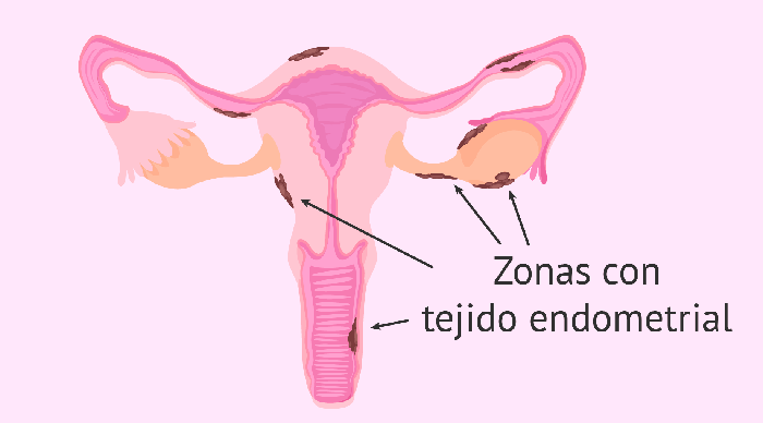 Localizacion Implantes De Endometriosis