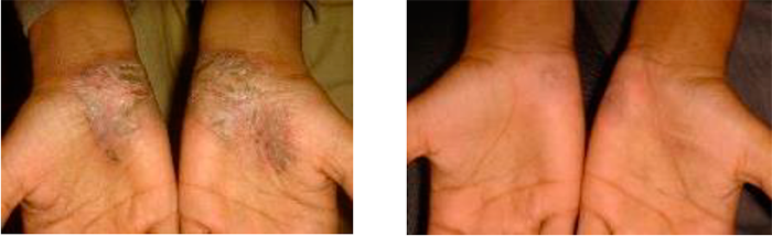 PSORIASIS REULTADOS FOTOTERAPIA